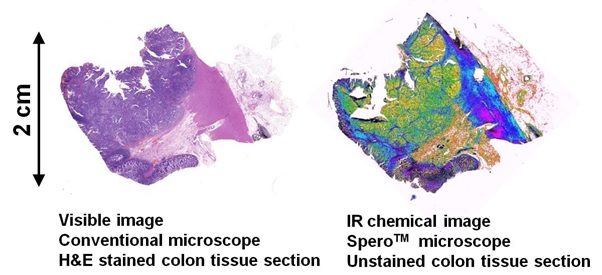 High-resolution, wide-area, IR chemical imaging with the Spero microscope (right) of an unstained 5-10 um thick section of a cancerous colon tissue with a total area of about 6 cm2 collected in a matter of minutes demonstrating the high-throughput capability of the system. In comparison, an H&E stained parallel section of the same colon tissue is shown on the left. The IR image provides a rich chemical contrast without the need for molecular tagging or staining.