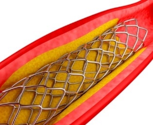 Metallographic Preparation of Stents and Orthopedics