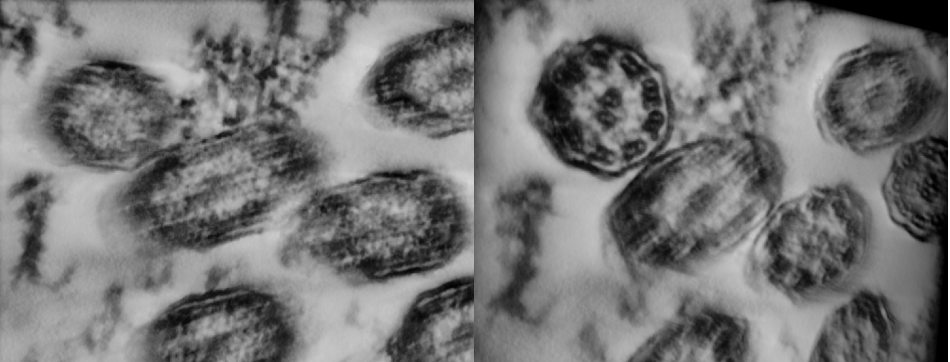 Close-ups of the reconstruction of cilia of a healthy individual untilted (left) and tilted to reveal the proto-typical view used for diagnostics (right). The tilt of the reconstruction was chosen to reveal the pattern in the upper left cilia.