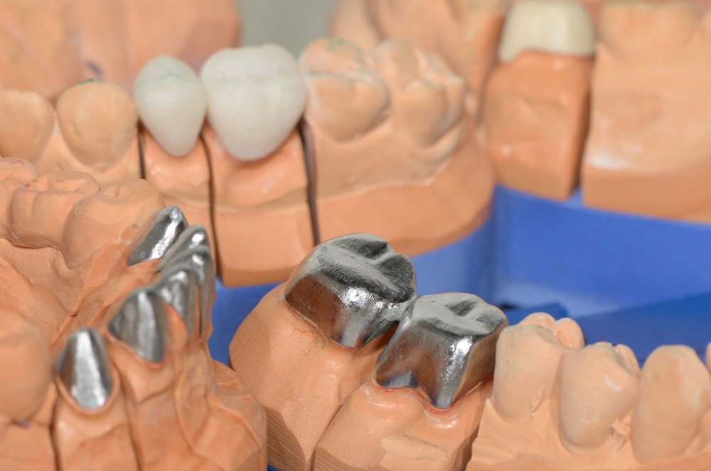 titanium, dental, dental cast, alloys, ti-cu, ti-cu alloy