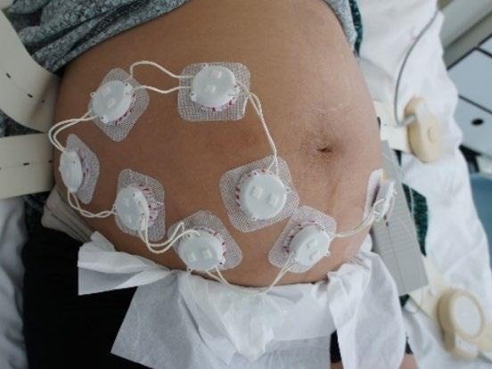 The ELAINE system measuring 8 fetal ECG leads on a pregnant patient at the Maternity Ward of the University Hospital of Bern (Bern Ethical Committee, Project ID: 2019-01899).