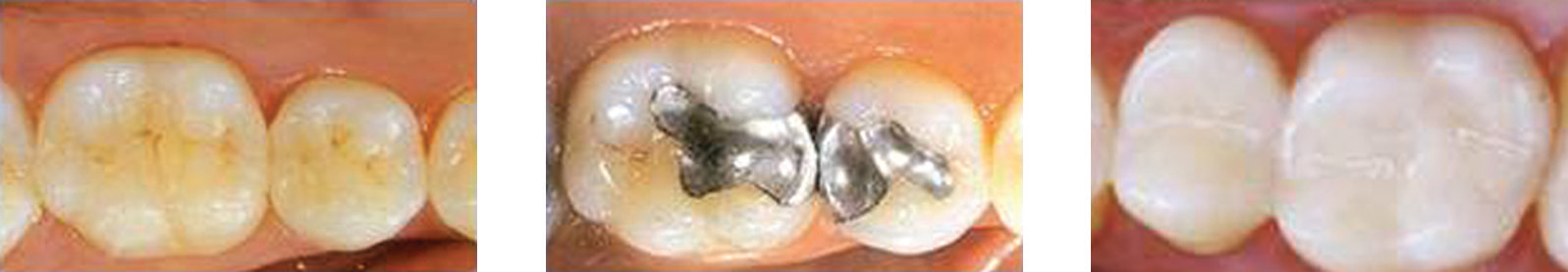 恢复牙科的例子,展示(一)陶瓷镶嵌;(b)汞合金修复;(c)复合材料。