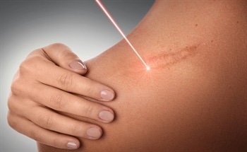 How Lasers Remove Tissues