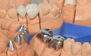 What Properties of Ti-Cu Alloys Make Them Suitable for Dentistry?