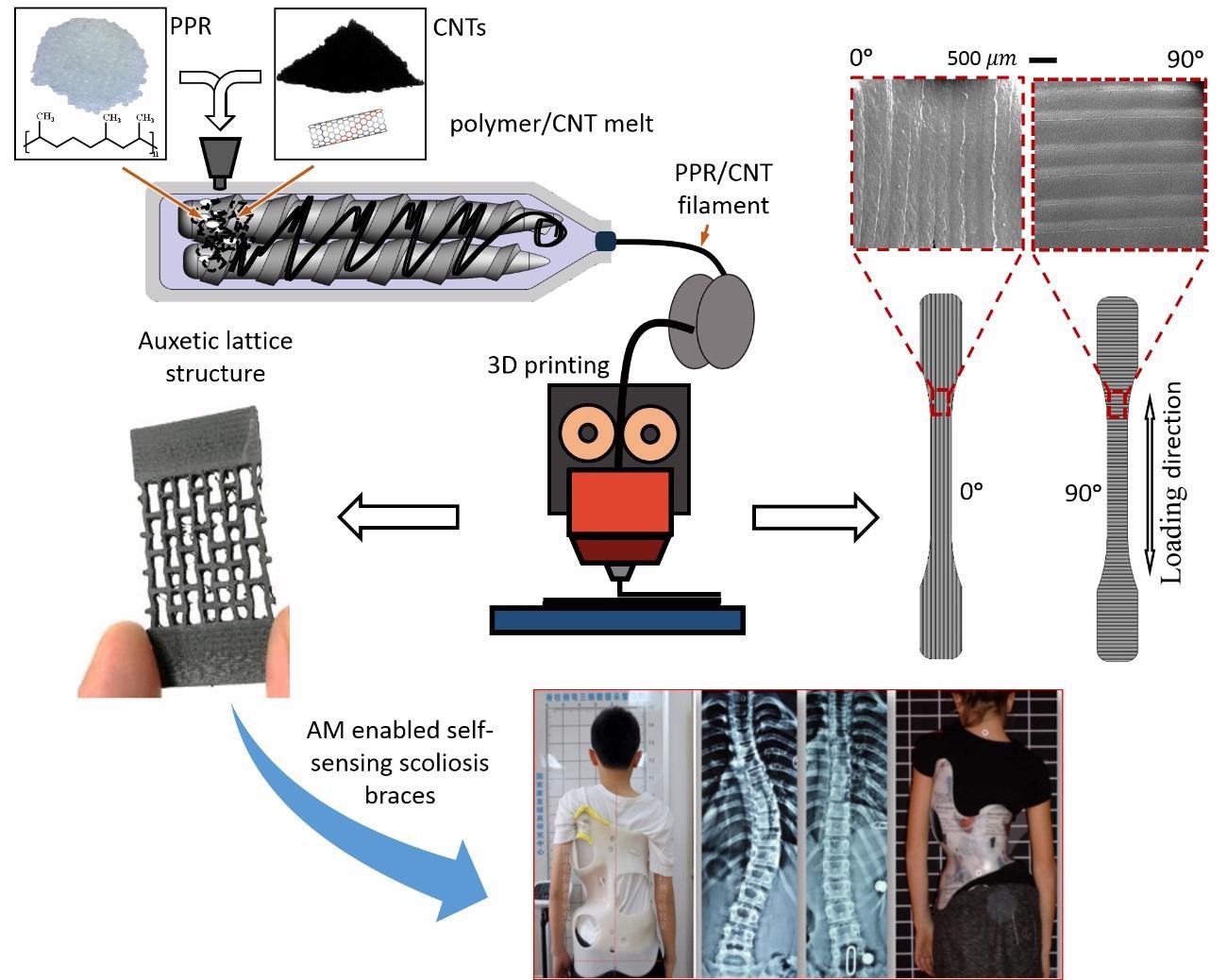 Researchers Invent “Smart” 3D-Printed Braces to Support Better Scoliosis Treatment Procedure