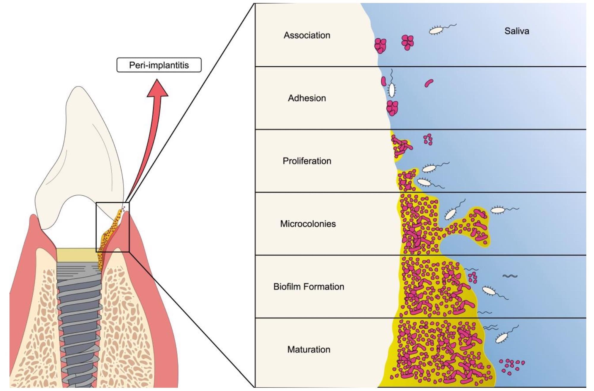 Schematic representation of oral biofilm formation on dental implants. The figure shows the different stages of bacterial biofilm formation ranging from adhesion to the establishment of the mature colony.