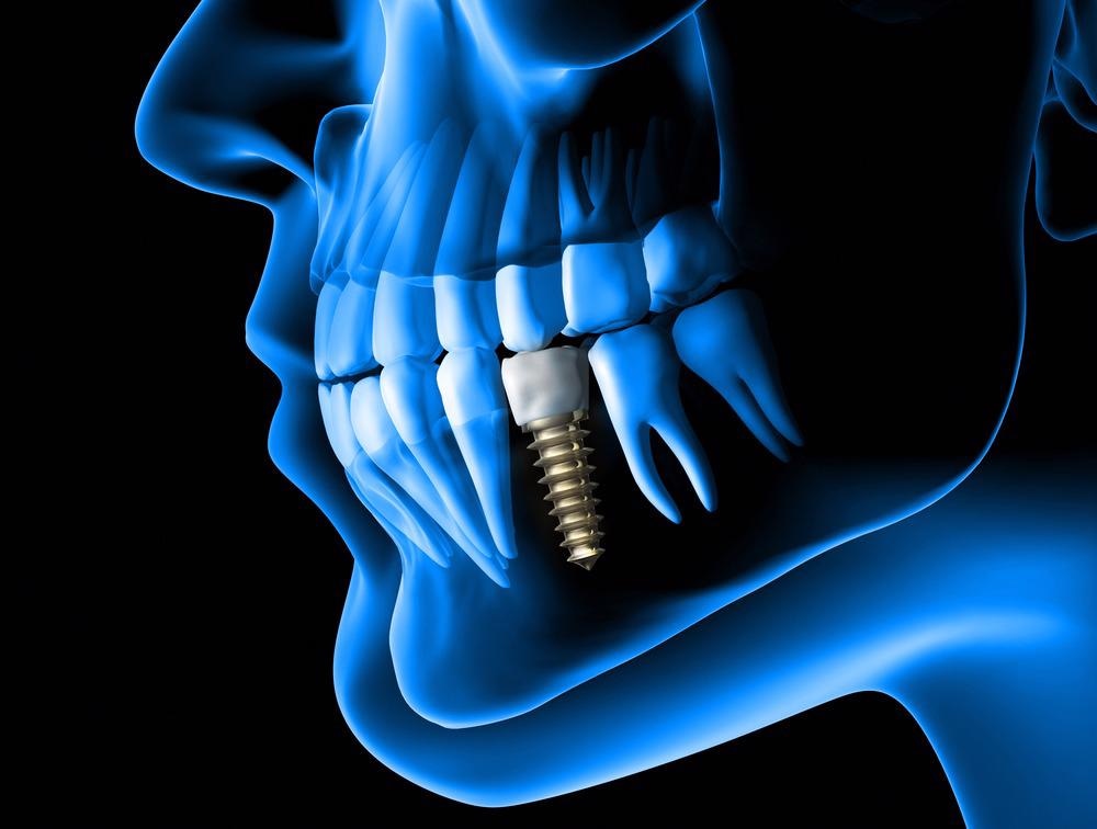 How Can Nanobiotechnology be Used to Improve the Safety of Titanium Dental Implants?