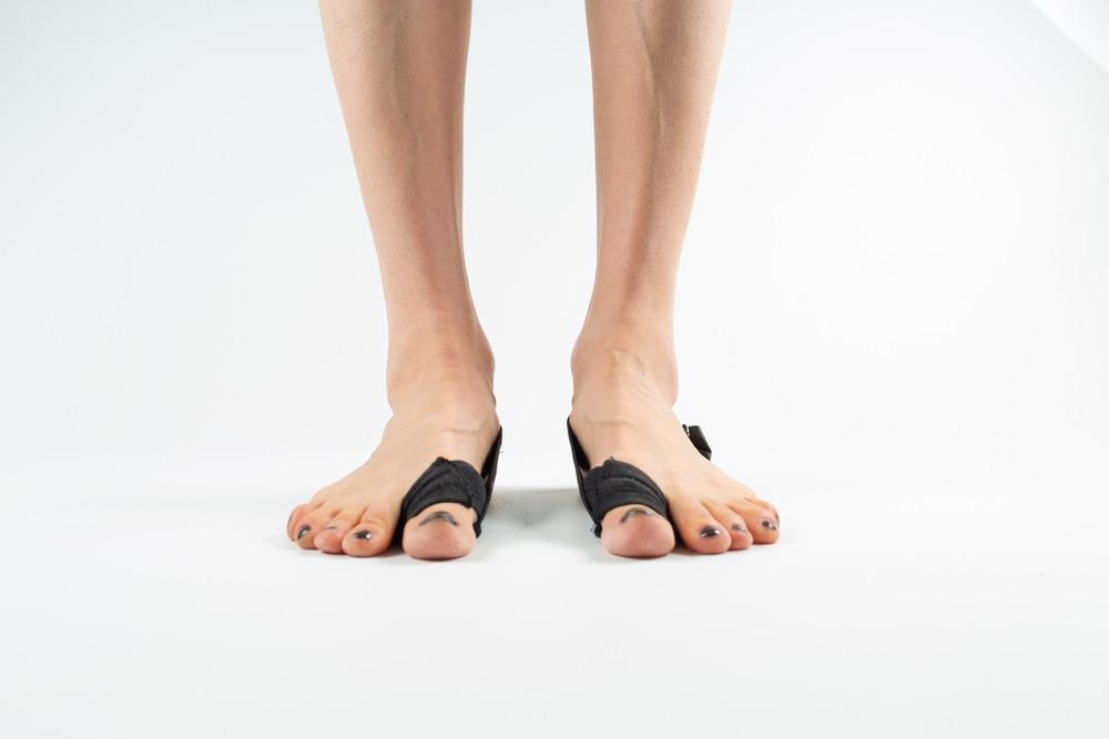 3D Printing Patient-Specific Foot Orthoses