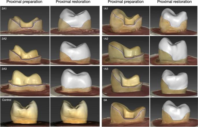 The tooth preparation and the overlay restoration design for each experiment group.