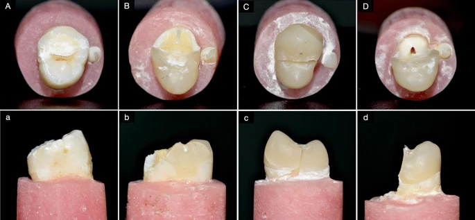 The characteristics of the observed fractures are shown in occlusal view (uppercase letters) and proximal view (lowercase letters). In the control group, the fracture was always within the dentin (A) and it was always above the CEJ (a). In the overlay-restored groups, four of the forty-two specimens involved only the restoration and dentin (B) and three of these unusual specimens were above the CEJ (b). All of the other overlay-restored specimens fractures involved pulp tissue (C and D) below the CEJ (c and d). Roughly half of those specimens fractured across the middle of the tooth (C and c), and in the others a large portion of the tooth fell off (D and d).