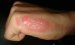 Successful Tests of Silver-Based Gels for Treating Burn Victims