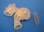 3D-Printed Heart Model for Treating Complex Aortic Aneurysm Benefits Teenager