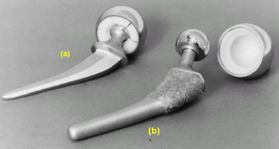 AZoJoMo – AZoM Journal of Materials Online - Types of stem used in total hip replacements: (a) cemented stem, and (b) press-fit stem.