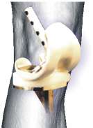 AZoM - Metals, Ceramics, Polymer and Composites : Titanium and Titanium Alloys as Biomaterials - Knee prosthesis