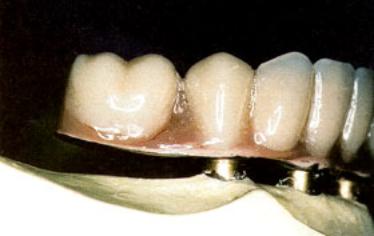 AZoM - Metals, Ceramics, Polymer and Composites : Titanium and Titanium Alloys as Biomaterials, dental implants, dentures,